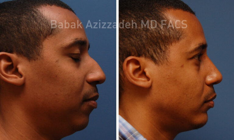 Transform Your Profile: Expert Nose Surgery for Aesthetic Enhancement