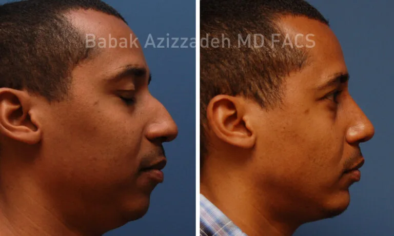 Transform Your Profile: Expert Nose Surgery for Aesthetic Enhancement